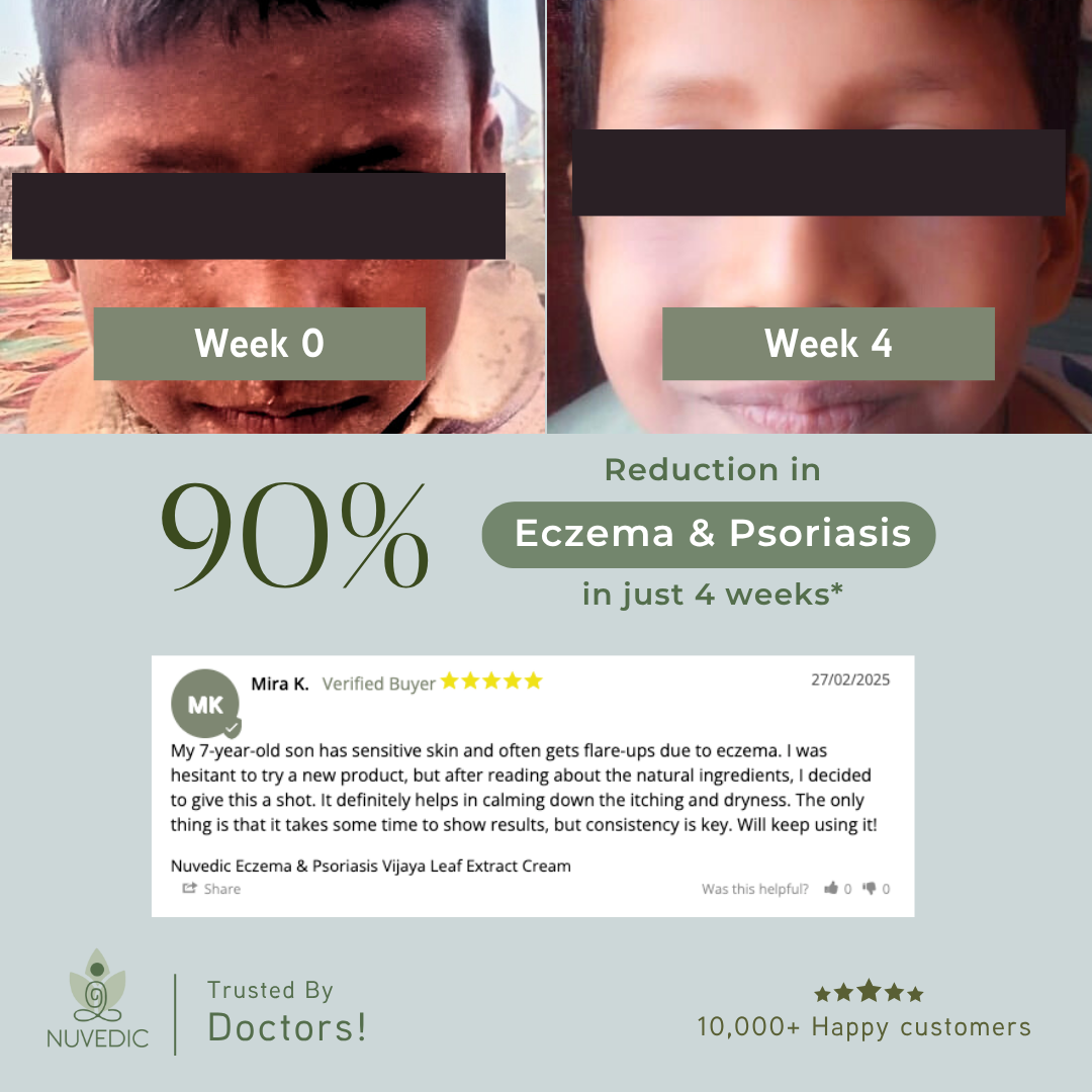 NUVEDIC Eczema & Psoriasis Vijaya Leaf Extract Cream
